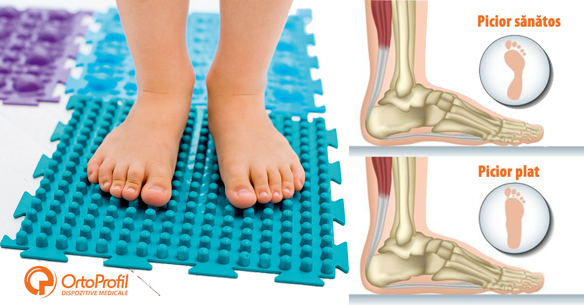 Picioare plate și dureri de gleznă - SFATUL SPECIALISTULUI